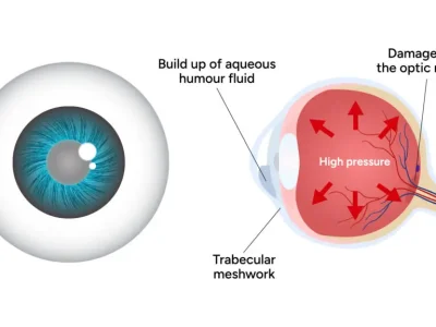 glaucoma-1-1024x576