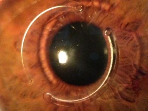 intracorneal